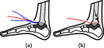 Insertion of a pressure sensing array minimally affects hindfoot bone kinematics